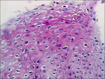 Initial excisional biopsy of the neocervix, showing marked nuclear atypia; magnification x400