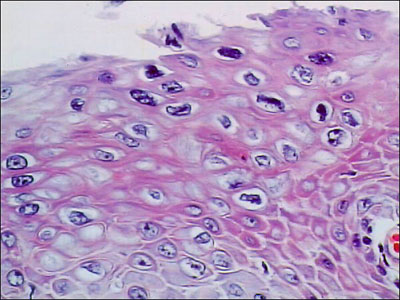 Initial excisional biopsy of the neocervix, showing dysplastic changes (VAIN II); magnification x160