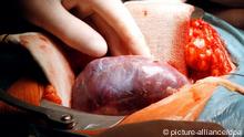 Eine frisch implantierte Niere wird vom Blut des Empfängers durchströmt (Foto: AP)